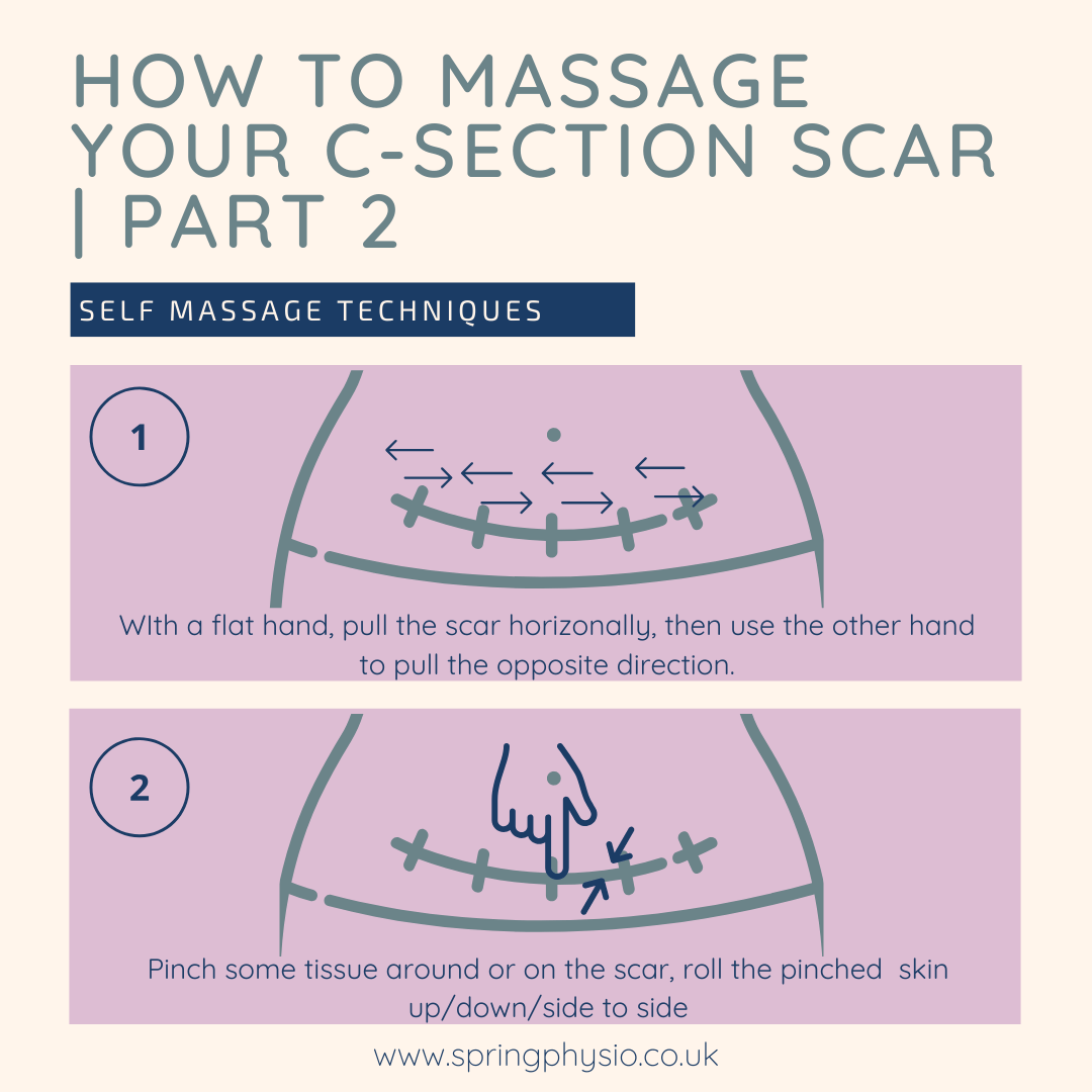 caesarean self massage