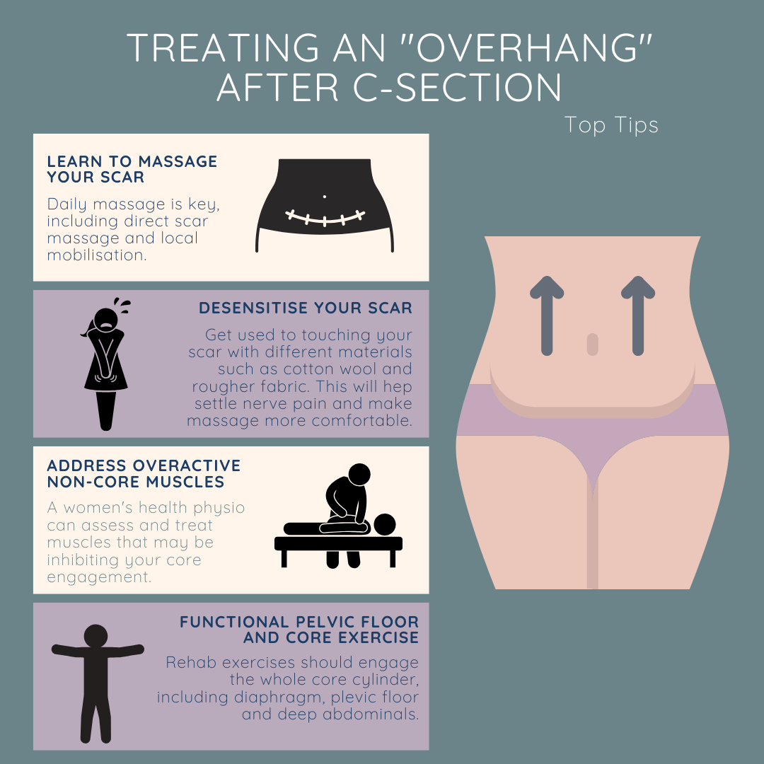 c-section overhang