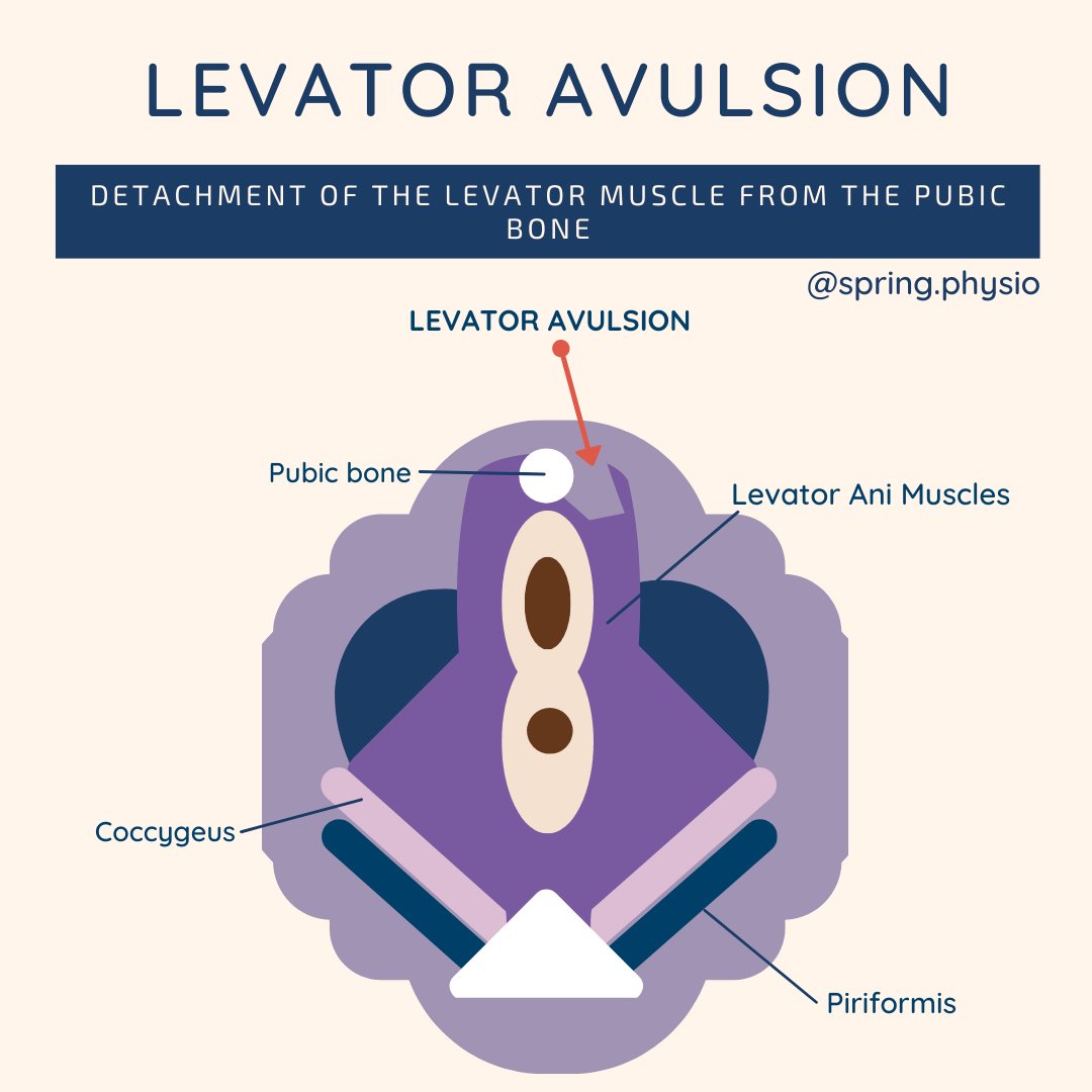 Levator avulsion of the pelvic floor